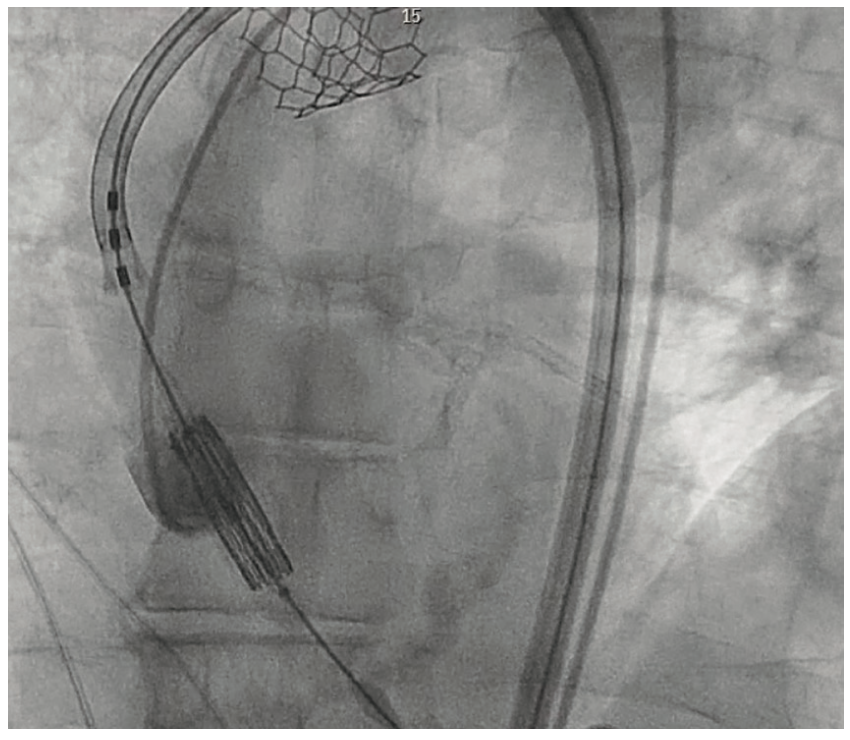 Embolization of Prosthetic Valve Into the Ascending Aorta During